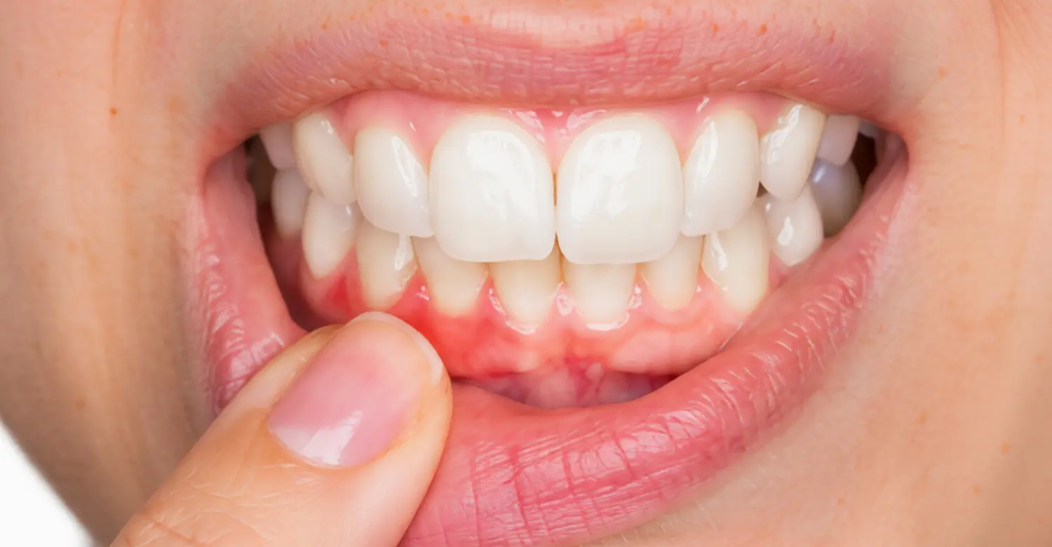 Can Periodontal Disease Be Stopped 2